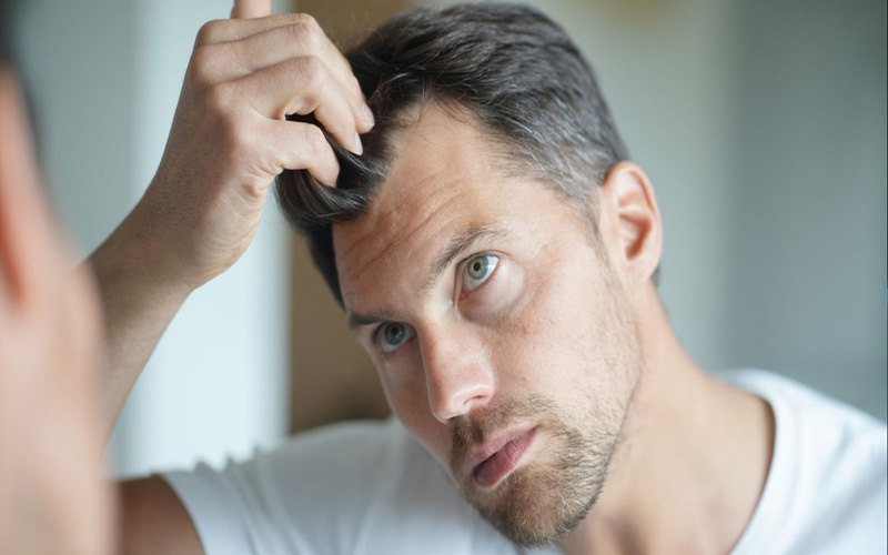 علت ریزش مو مردان